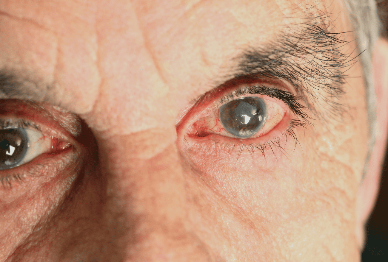 Illustration de la perte du champ visuel liée au glaucome